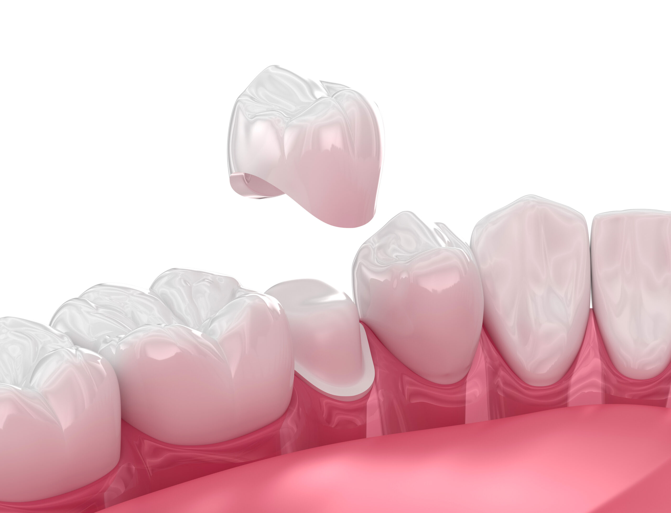 Couronnes / CEREC